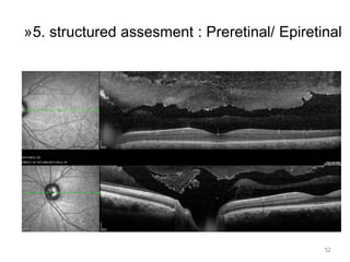 52
»5. structured assesment : Preretinal/ Epiretinal
 