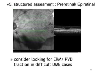 53
» consider looking for ERM/ PVD
traction in difficult DME cases
»5. structured assesment : Preretinal/ Epiretinal
 