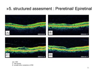 A,B : PVD
C : VM traction
D. remodel after completion of PVD
55
»5. structured assesment : Preretinal/ Epiretinal
 