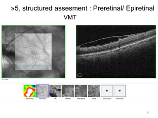 57
»5. structured assesment : Preretinal/ Epiretinal
VMT
 