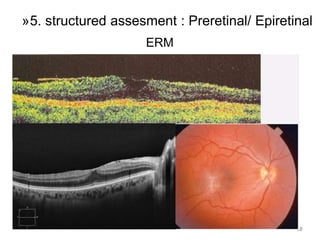 58
»5. structured assesment : Preretinal/ Epiretinal
ERM
 