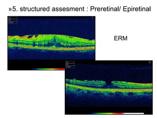 59
»5. structured assesment : Preretinal/ Epiretinal
ERM
 