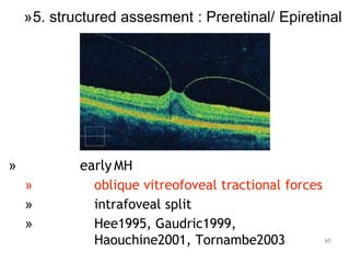 » early MH
» oblique vitreofoveal tractional forces
» intrafoveal split
» Hee1995, Gaudric1999,
Haouchine2001, Tornambe2003 60
»5. structured assesment : Preretinal/ Epiretinal
 