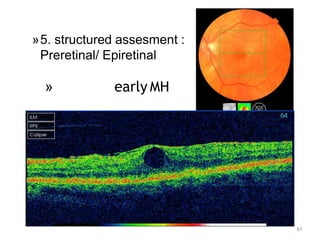 61
»5. structured assesment :
Preretinal/ Epiretinal
» early MH
 
