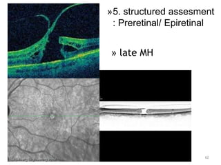 » late MH
62
»5. structured assesment
: Preretinal/ Epiretinal
 