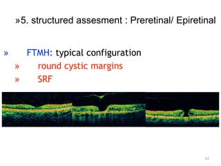» FTMH: typical configuration
» round cystic margins
» SRF
63
»5. structured assesment : Preretinal/ Epiretinal
 