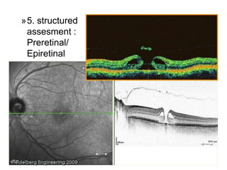 64
»5. structured
assesment :
Preretinal/
Epiretinal
 