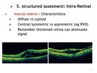» macula edema : Characteristics
» diffuse vs cystoid
» Central/symmetric vs asymmetric (eg RVO)
» Remember thickened retina can attenuate
signal
67
» 5. structured assesment: Intra-Retinal
 