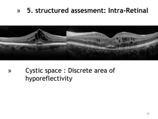 » Cystic space : Discrete area of
hyporeflectivity
68
» 5. structured assesment: Intra-Retinal
 