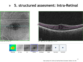 Case courtesy of Dr. Scott Lee, East Bay Retina Consultants, Oakland, CA, USA
69
» 5. structured assesment: Intra-Retinal
 