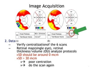Image Acquisition
7
2. Data verification and validation
– Verify centralizationof the 6 scans
– Retinal map(single eye), retinal
thickness/volume (OU) analyze protocols
»SD should be around 0 mcm
»SD > 30 mcm
» poor centration
» do the scan again
 