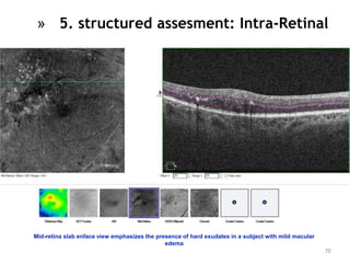 Mid-retina slab enface view emphasizes the presence of hard exudates in a subject with mild macular
edema
70
» 5. structured assesment: Intra-Retinal
 