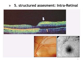 71
» 5. structured assesment: Intra-Retinal
 