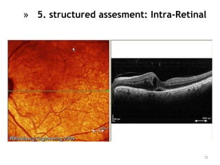 72
» 5. structured assesment: Intra-Retinal
 