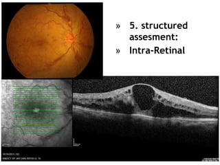73
» 5. structured
assesment:
» Intra-Retinal
 