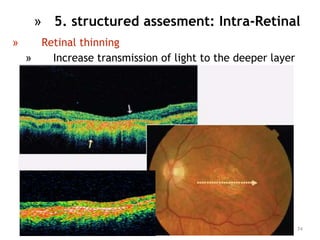 » Retinal thinning
» Increase transmission of light to the deeper layer
74
» 5. structured assesment: Intra-Retinal
 
