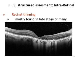 75
» 5. structured assesment: Intra-Retinal
» Retinal thinning
» mostly found in late stage of many
diseases
 