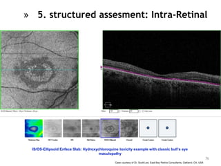 IS/OS-Ellipsoid Enface Slab: Hydroxychloroquine toxicity example with classic bull’s eye
maculopathy
Case courtesy of Dr. Scott Lee, East Bay Retina Consultants, Oakland, CA, USA
76
» 5. structured assesment: Intra-Retinal
 