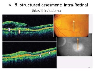 77
» 5. structured assesment: Intra-Retinal
thick/ thin/ edema
 