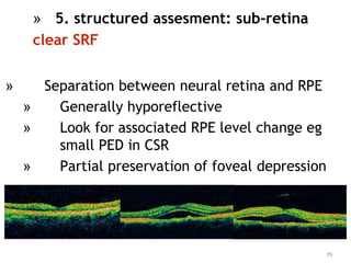 » Separation between neural retina and RPE
» Generally hyporeflective
» Look for associated RPE level change eg
small PED in CSR
» Partial preservation of foveal depression
79
» 5. structured assesment: sub-retina
clear SRF
 