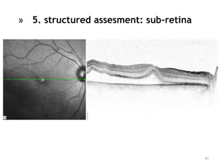 81
» 5. structured assesment: sub-retina
 