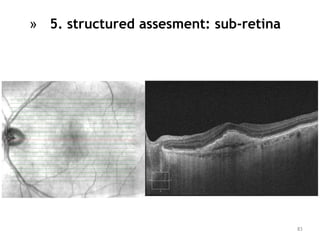 83
» 5. structured assesment: sub-retina
 