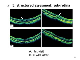 84
» 5. structured assesment: sub-retina
A. 1st visit
B. 6 wks after
 