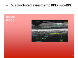 - drusen
- RPED
87
» 5. structured assesment: RPE/ sub-RPE
 