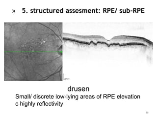 88
» 5. structured assesment: RPE/ sub-RPE
drusen
Small/ discrete low-lying areas of RPE elevation
c highly reflectivity
 