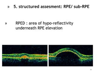 » RPED : area of hypo-reflectivity
underneath RPE elevation
89
» 5. structured assesment: RPE/ sub-RPE
 