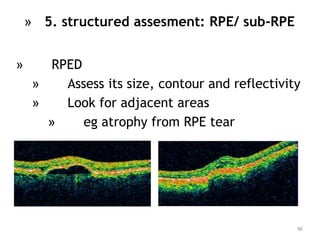 » RPED
» Assess its size, contour and reflectivity
» Look for adjacent areas
» eg atrophy from RPE tear
90
» 5. structured assesment: RPE/ sub-RPE
 