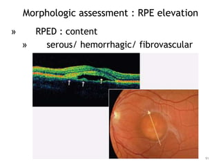 Morphologic assessment : RPE elevation
» RPED : content
» serous/ hemorrhagic/ fibrovascular
91
 