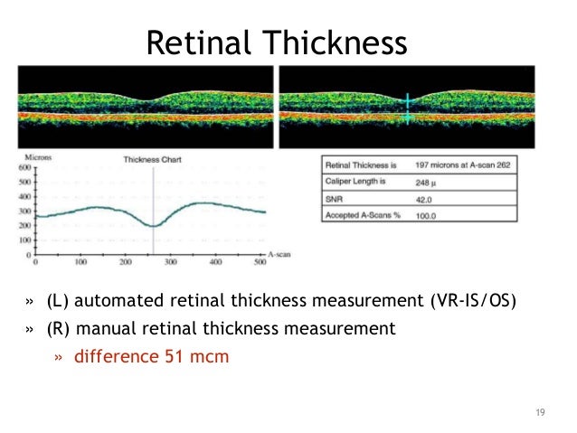 Retinal Thickness Measurement: Macular Thickness Measurements – ITHRE