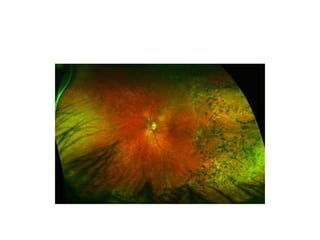 Nw2016 retinitis pigmentosa