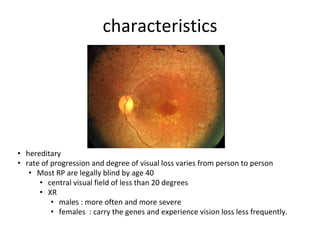 characteristics
• hereditary
• rate of progression and degree of visual loss varies from person to person
• Most RP are legally blind by age 40
• central visual field of less than 20 degrees
• XR
• males : more often and more severe
• females : carry the genes and experience vision loss less frequently.
 