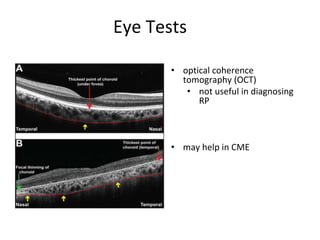 Eye Tests
• optical coherence
tomography (OCT)
• not useful in diagnosing
RP
• may help in CME
 