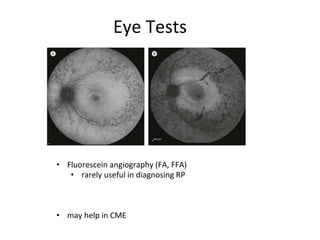 Eye Tests
• Fluorescein angiography (FA, FFA)
• rarely useful in diagnosing RP
• may help in CME
 