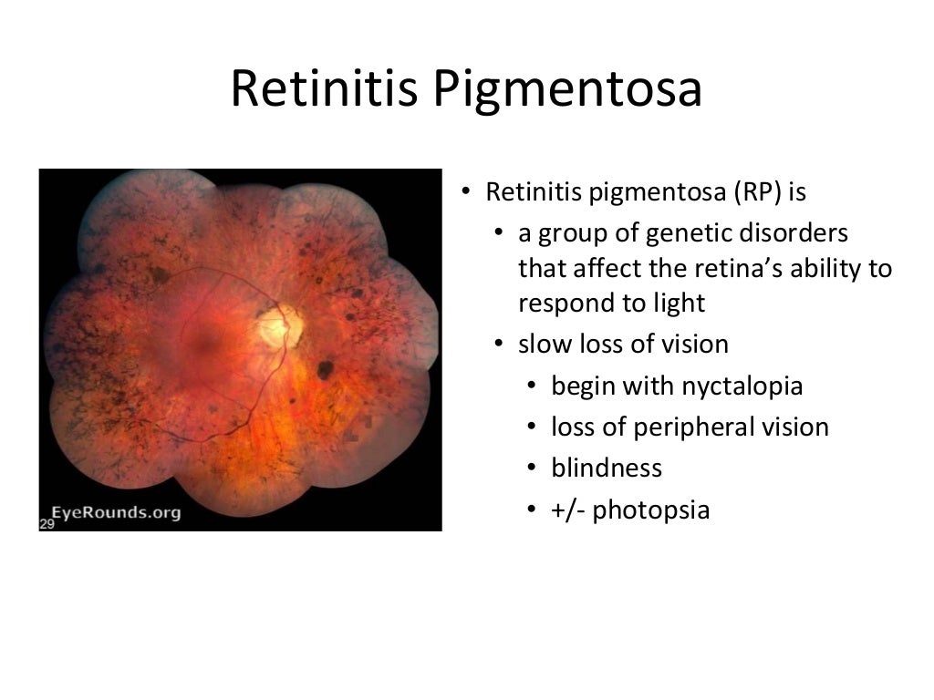 Nw2016 retinitis pigmentosa