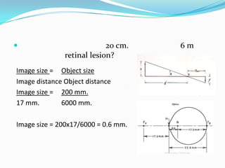 

20 cm.
retinal lesion?

Image size = Object size
Image distance Object distance
Image size = 200 mm.
17 mm.
6000 mm.
Image size = 200x17/6000 = 0.6 mm.

6m

 