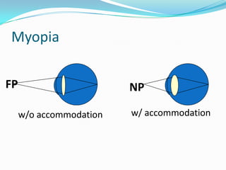 Myopia
FP

NP
w/o accommodation

w/ accommodation

 