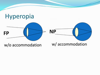 Hyperopia
FP
w/o accommodation

NP
w/ accommodation

 