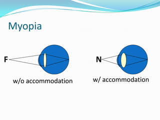 Myopia
F

N
w/o accommodation

w/ accommodation

 