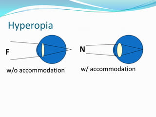 Hyperopia
F

N

w/o accommodation

w/ accommodation

 
