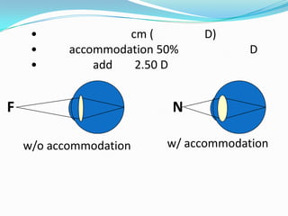 •
•
•

cm (
accommodation 50%
add
2.50 D

F

D)

D

N
w/o accommodation

w/ accommodation

 