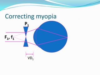 Correcting myopia
P1
F1, f1

VD1

 