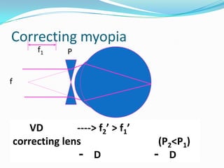 Correcting myopia
f1

P

f

VD
----> f2’ > f1’
correcting lens
- D

(P2<P1)
- D

 