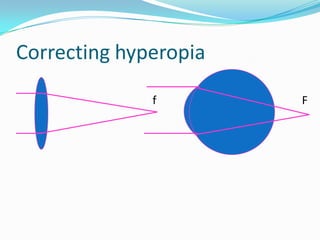 Correcting hyperopia
f

F

 