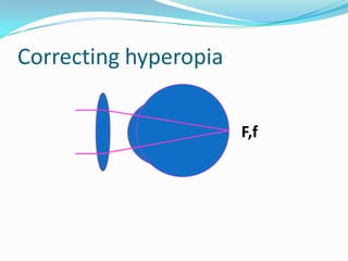 Correcting hyperopia
F,f

 