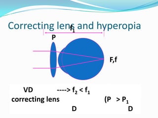 Correcting lens and hyperopia
f1
P
F,f

VD
----> f2 < f1
correcting lens
D

(P > P1
D

 