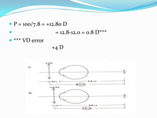  P = 100/7.8 = +12.80 D


= 12.8-12.0 = 0.8 D***

 *** VD error

+4 D

 